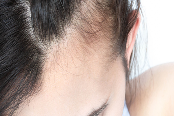 A importância da avaliação dermatológica na queda de cabelos