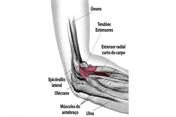 Epicondilite lateral: dor conhecida como “cotovelo do tenista” e que não atinge apenas esportistas