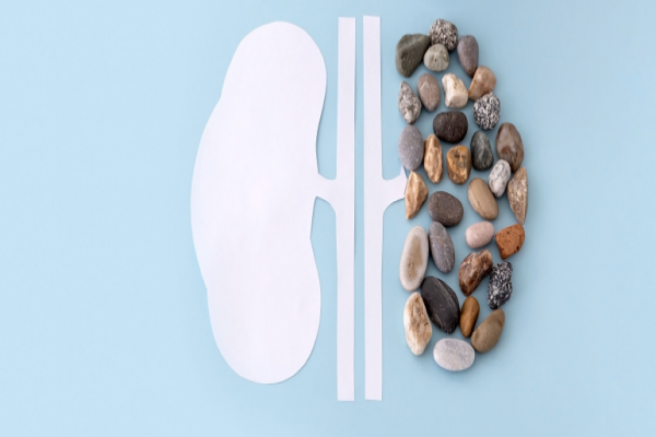 Como evitar as pedras nos rins?