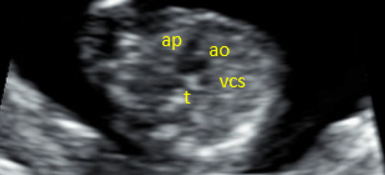 Ecocardiografia Fetal Precoce